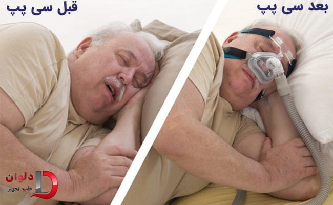 تاثیر استفاده از سی پپ قبل و بعد